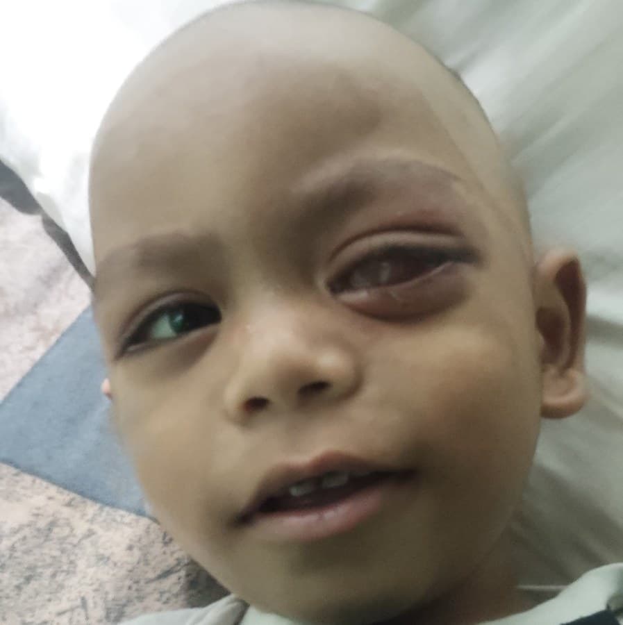 Master Rohit Kumar — Eye Cancer (Retinoblastoma)