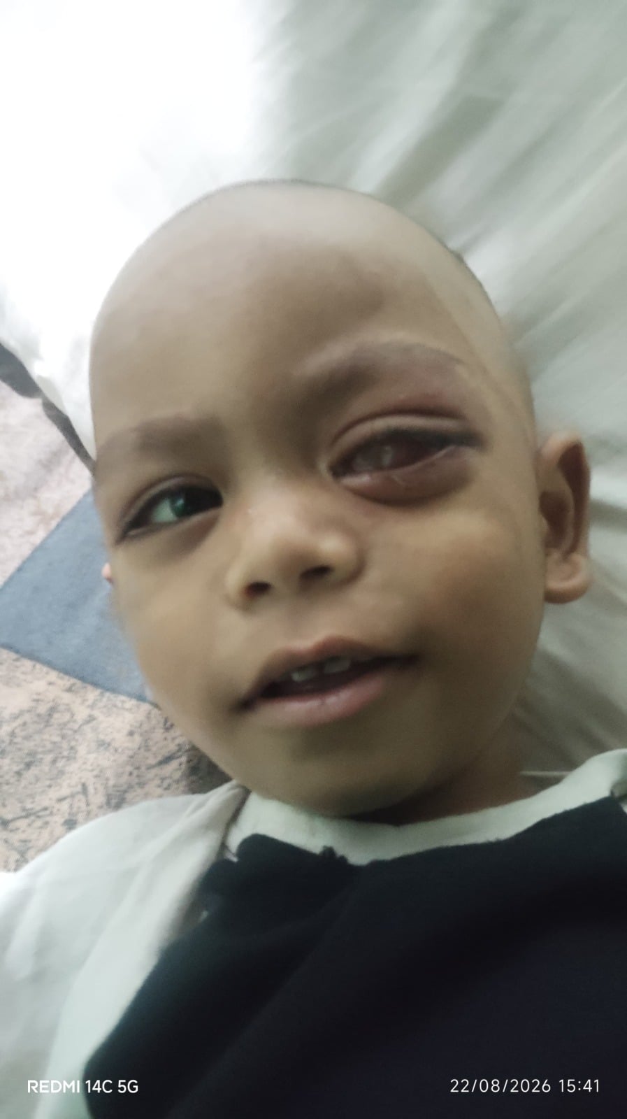 Master Rohit Kumar — Eye Cancer (Retinoblastoma)