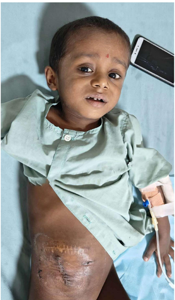 Master Abhinav — Blood Cancer B-ALL with Colostomy